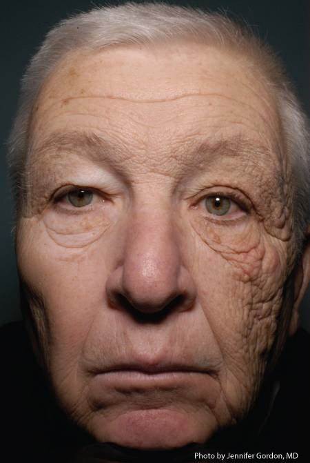 Conducteur de camion montrant les effets du vieillissement solaire asymétrique sur le visage