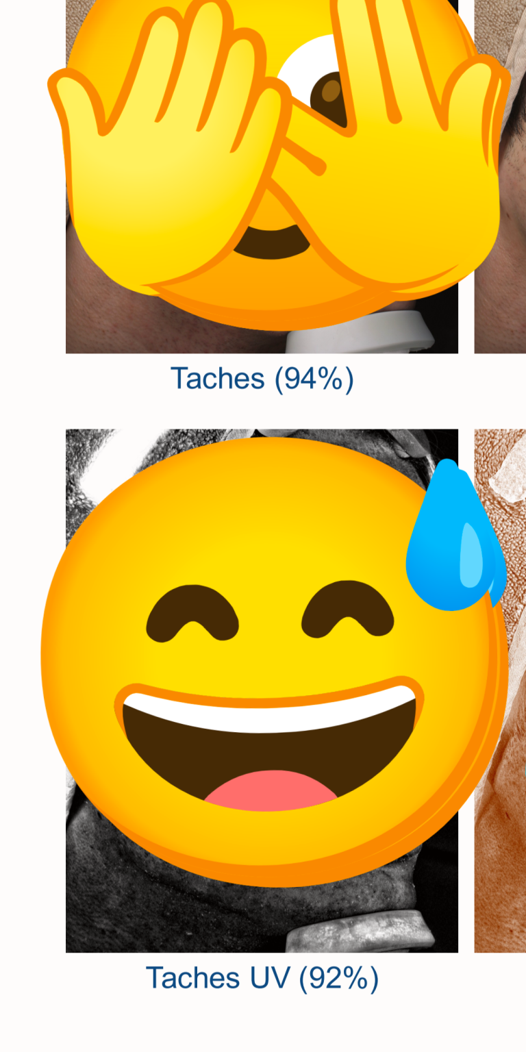 Résultat analyse Visia côté gauche montrant 92% de capital solaire préservé